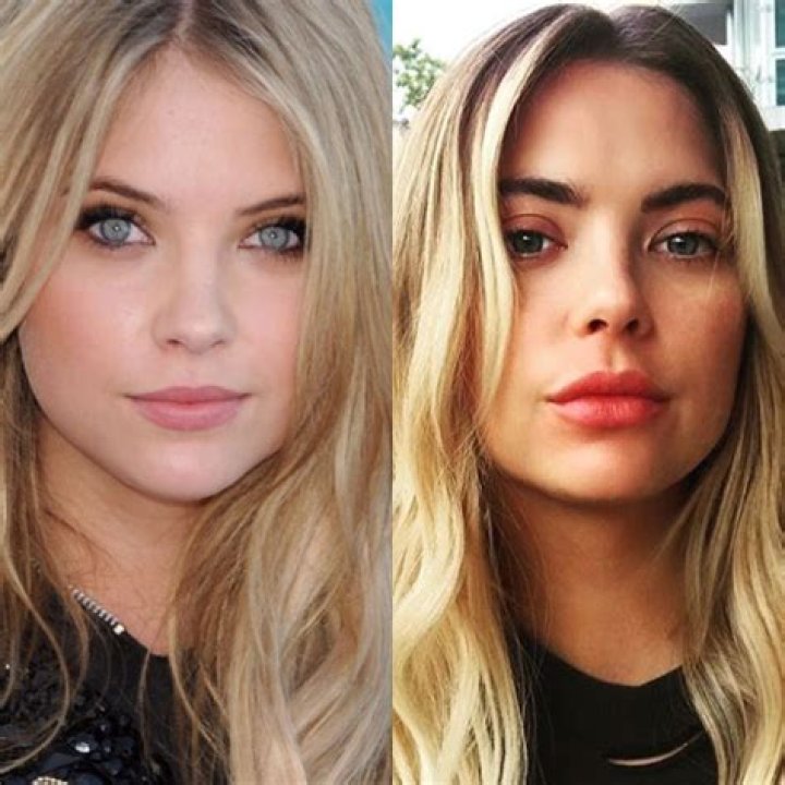 Ashley Benson Plastic Surgery Before and After