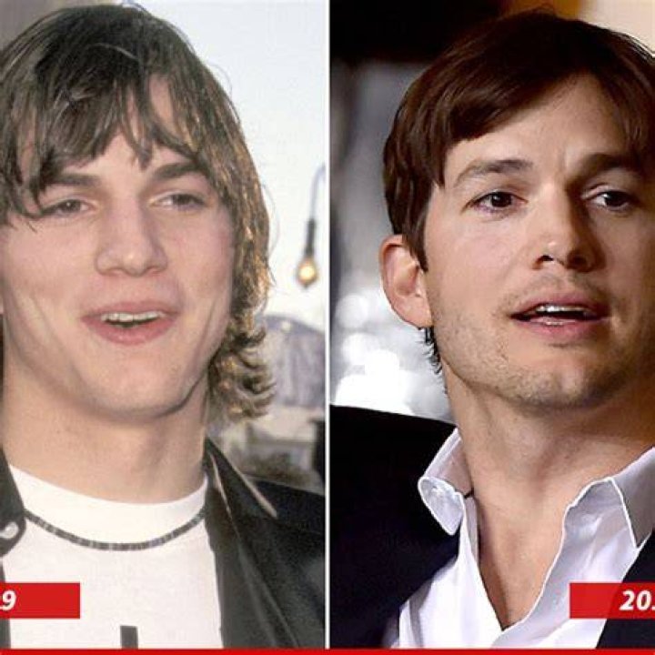 Ashton Kutcher Plastic Surgery Before and After