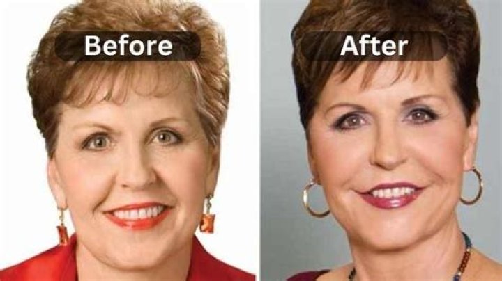 Joyce Meyer Lip Augmentation Plastic Surgery Before and After