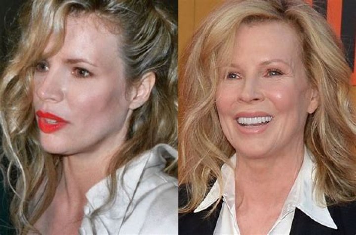 Kim Basinger Plastic Surgery Before and After